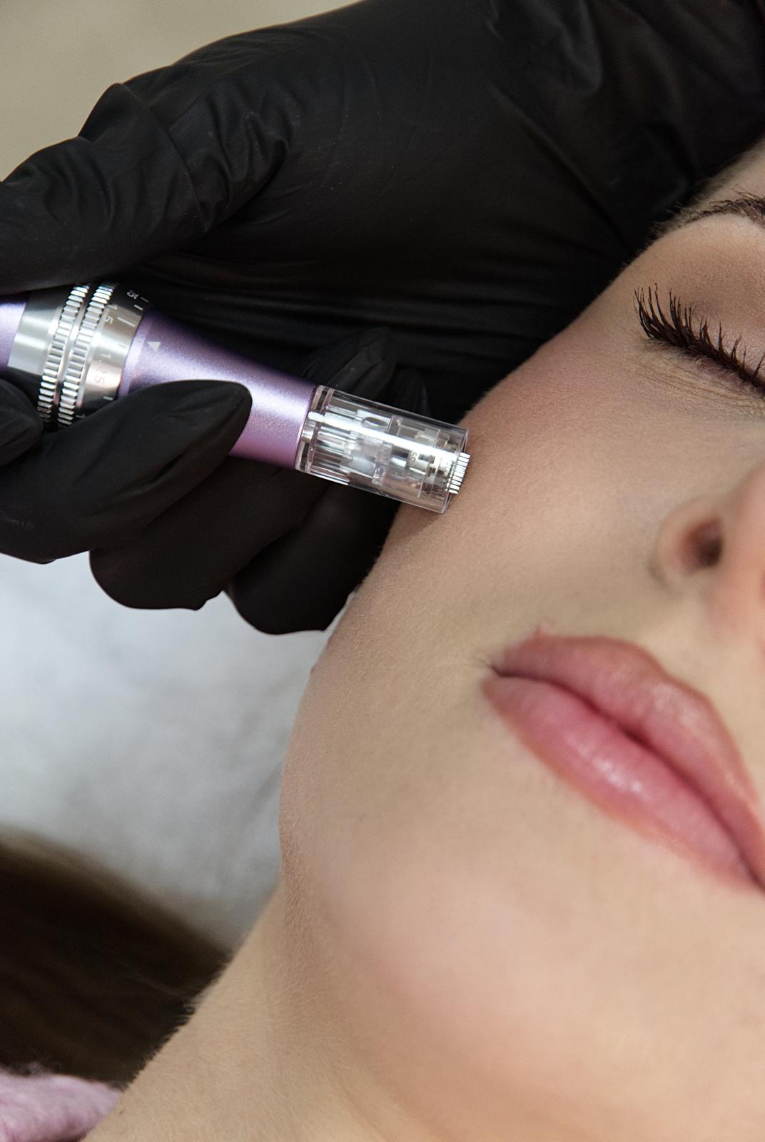 Microneedling